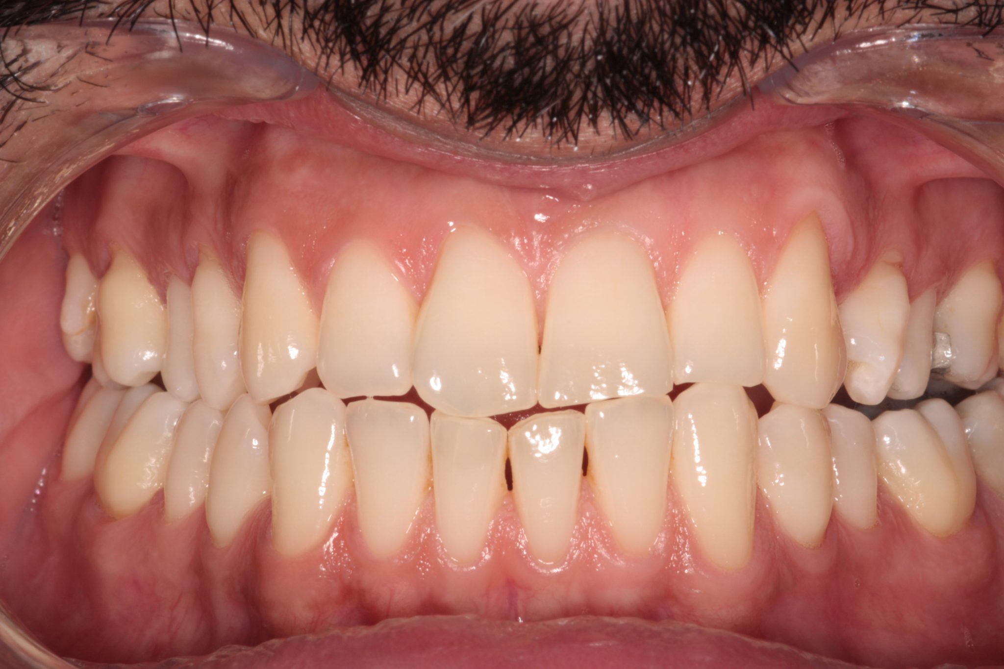 Composite Bonding and Invisalign Linton Dental Preston