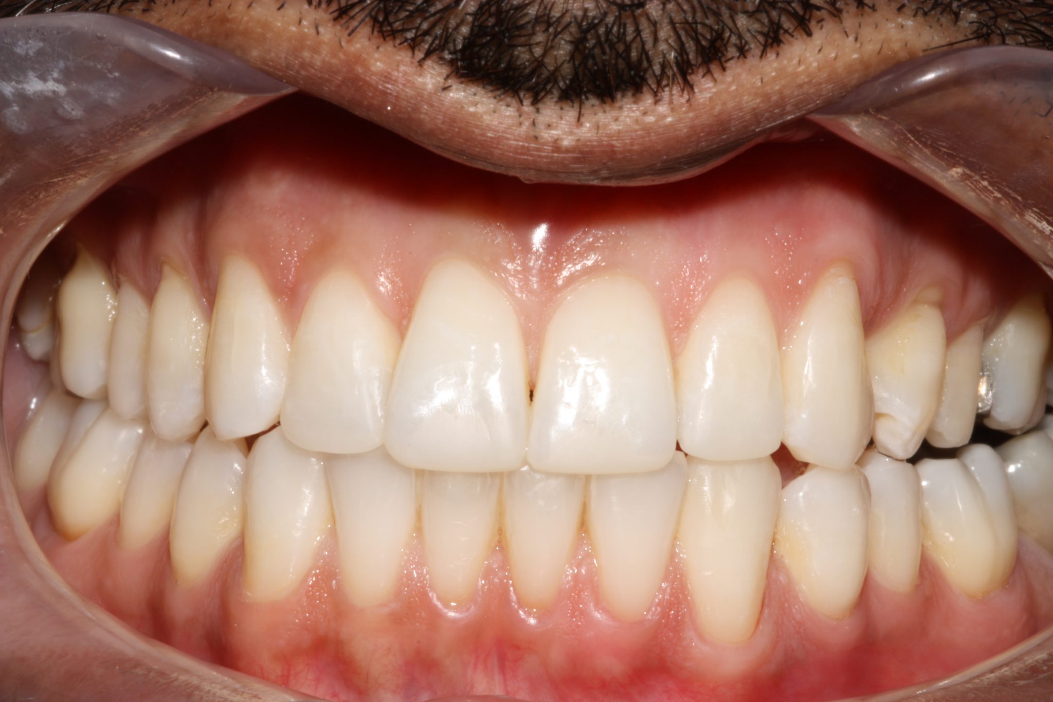 Composite Bonding and Invisalign Linton Dental Preston