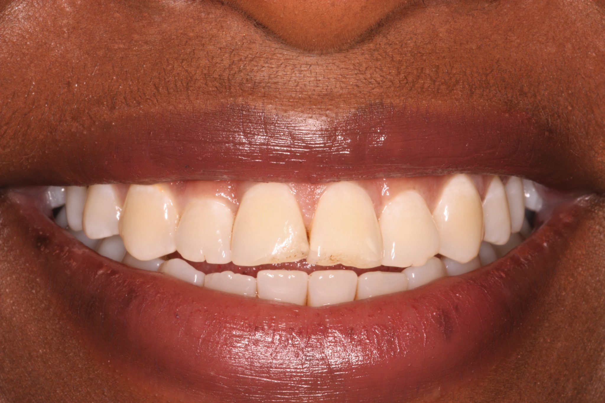 Aspen dental teeth whitening price