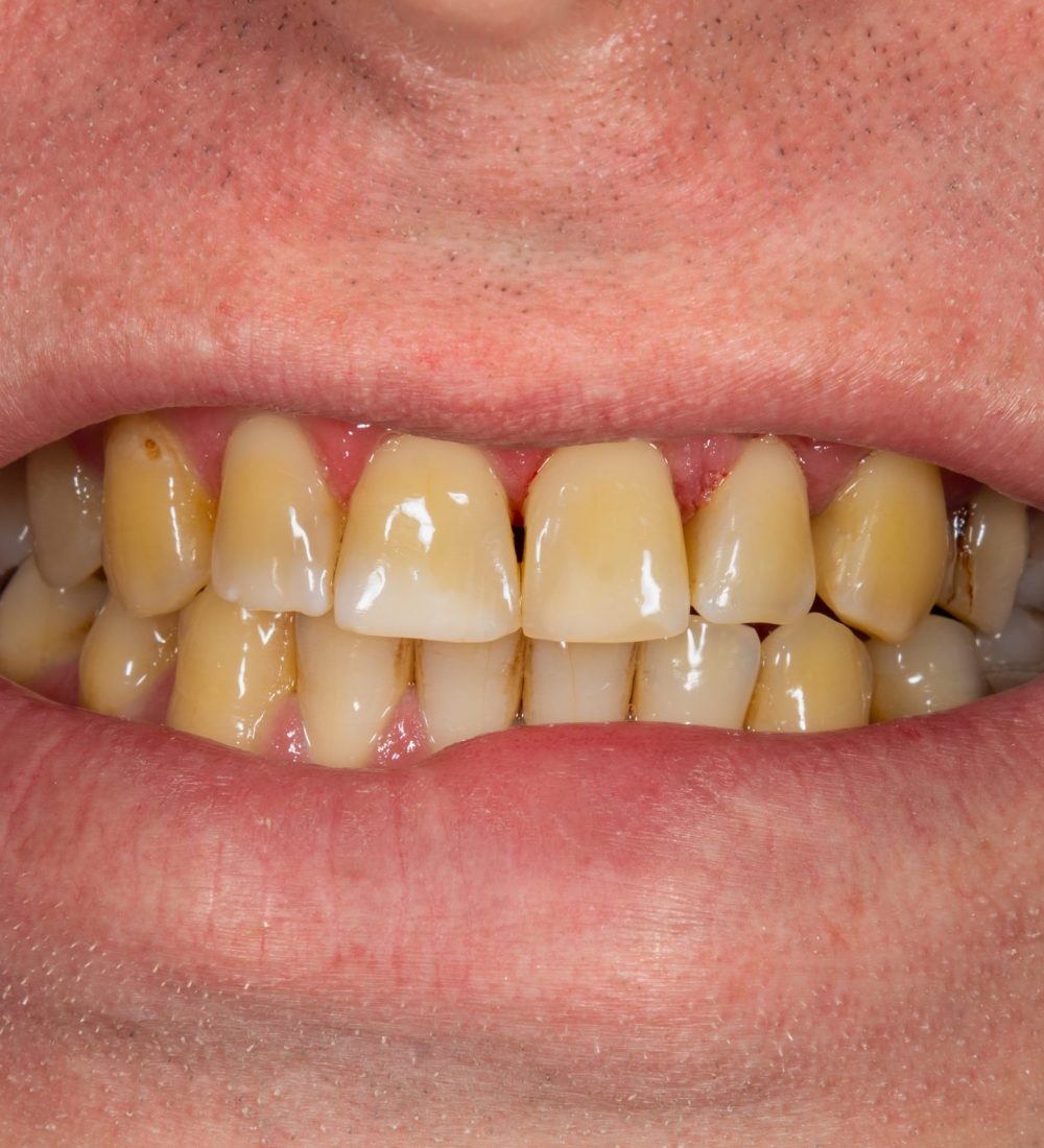 Dentists In Preston, Dental Implants, Veneers Preston Linton Dental