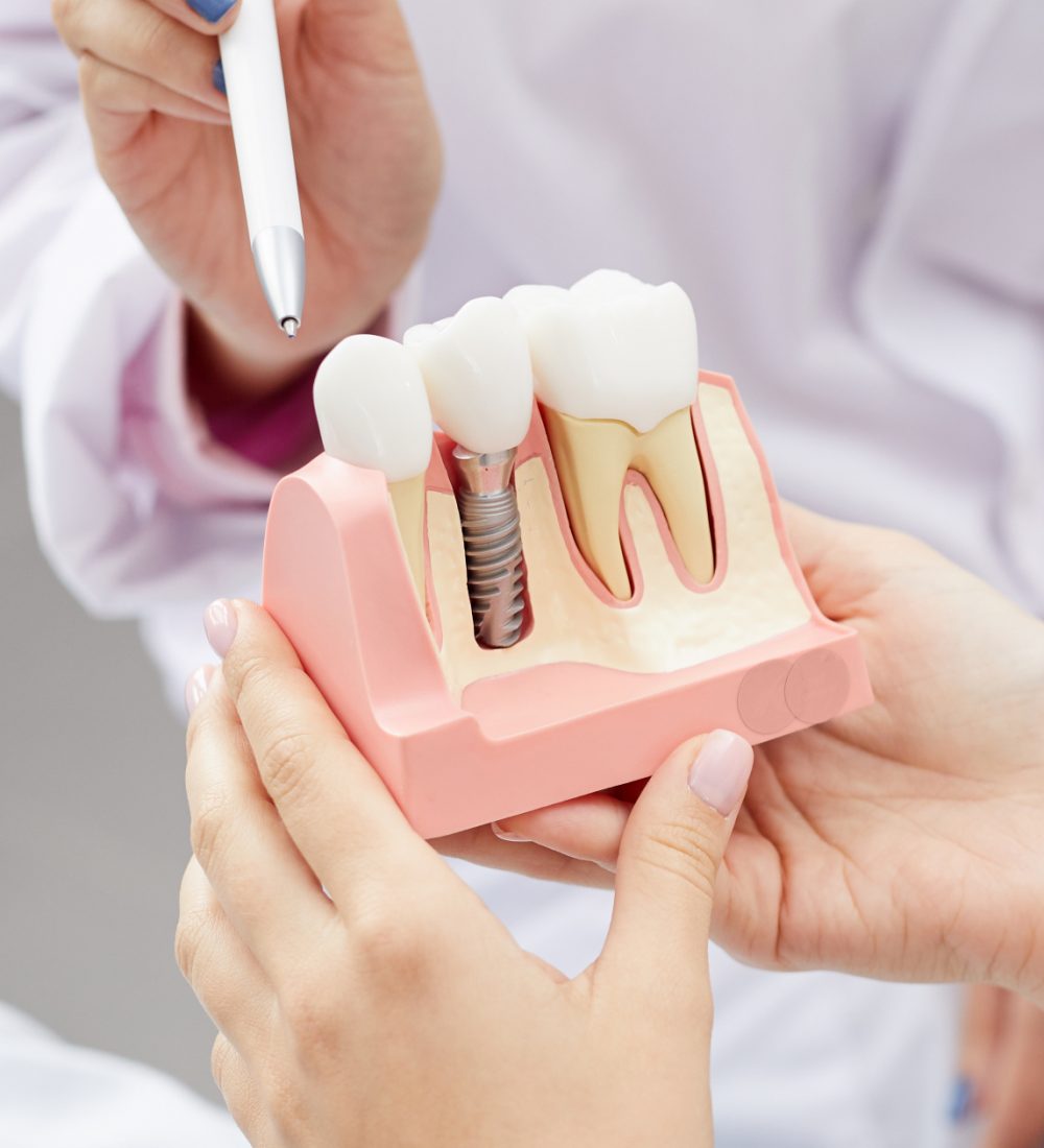Tooth Implants Preston